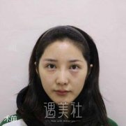 李战强隆鼻案例：八大处的医生就是牛啤 width=