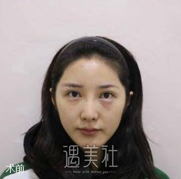 李战强,隆鼻,八大处