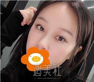 范飞,隆鼻