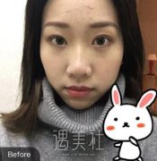 铜雀台周柯做的鼻子怎么样？全新隆鼻案例+果图来袭 width=