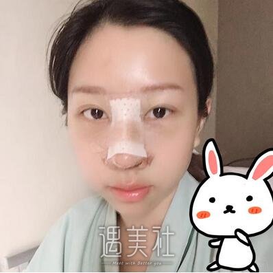 周柯,隆鼻