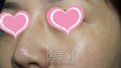 安医附院光子嫩肤怎么样 来谈谈我的体会 width=