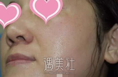 安医附院,光子嫩肤