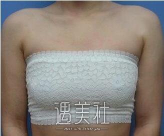 罗盛康,丰胸