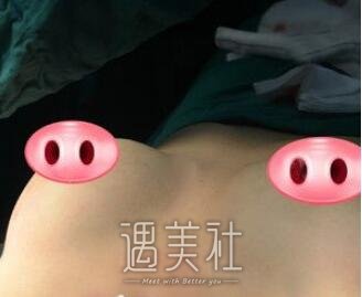 罗盛康,丰胸
