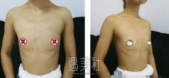 李朕,自体脂肪丰胸