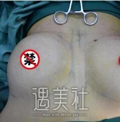 李朕,自体脂肪丰胸
