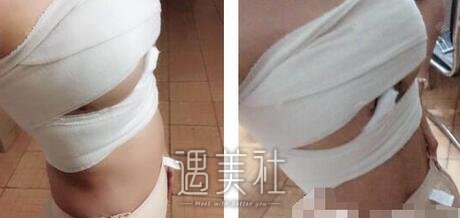 李朕,自体脂肪丰胸