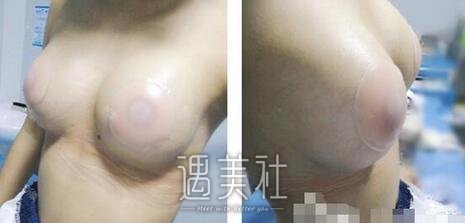 李朕,自体脂肪丰胸