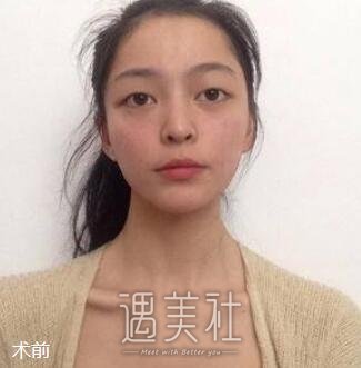 张恒术,双眼皮