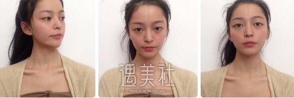 张恒术,双眼皮