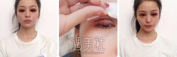 张恒术,双眼皮