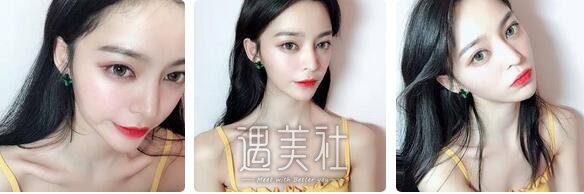 张恒术,双眼皮
