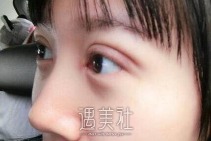 李东,双眼皮