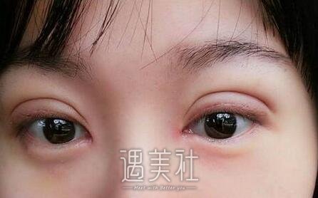 李东,双眼皮