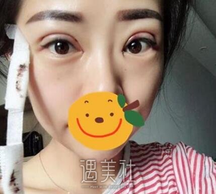 杨杰,双眼皮