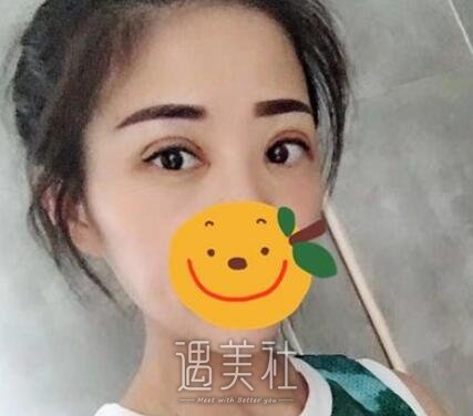 杨杰,双眼皮