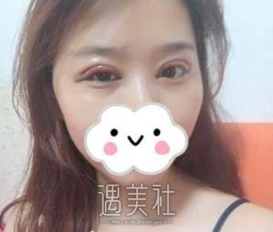 杨亚益,双眼皮