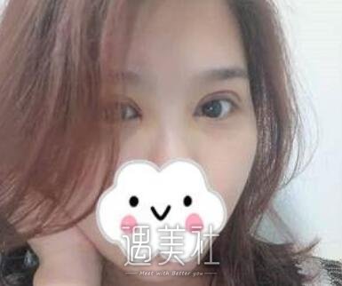 杨亚益,双眼皮