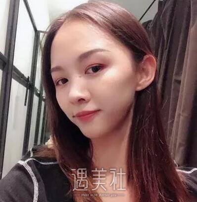 韦敏,隆鼻