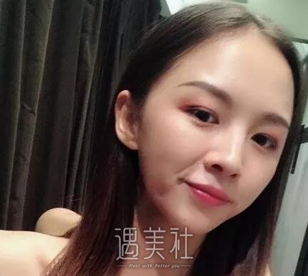 韦敏,隆鼻