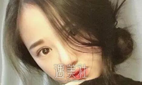 韦敏,隆鼻