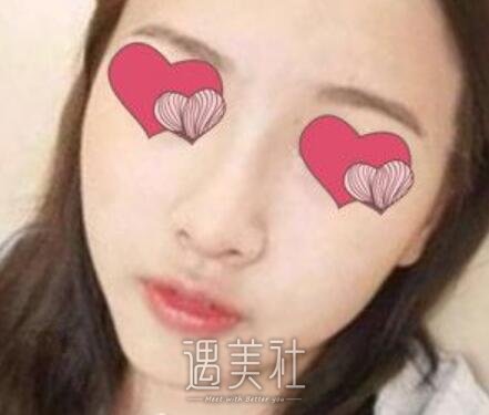 汪福强,隆鼻