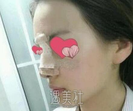 汪福强,隆鼻