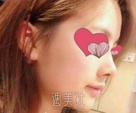 汪福强,隆鼻