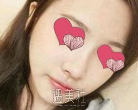 汪福强,隆鼻
