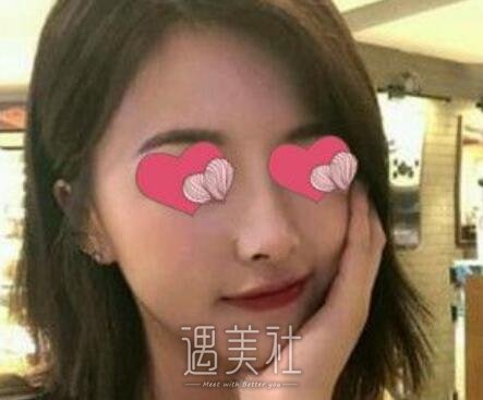 汪福强,隆鼻