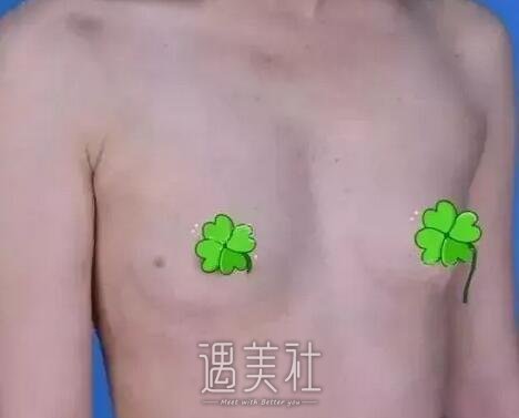 石蕾,丰胸