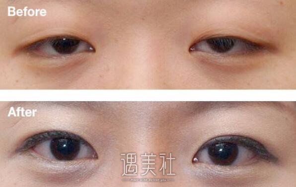 天津眼睑下垂手术大概需要多少钱，价格高低如何决定?