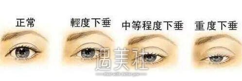 天津眼睑下垂手术大概需要多少钱，价格高低如何决定?