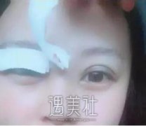 周口缔莱美整形医院双眼皮技术如何?有相关案例分享吗? width=