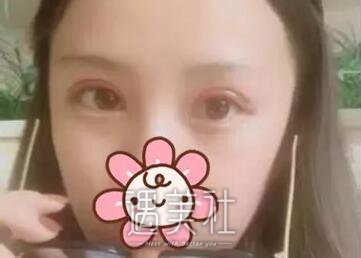 周口缔莱美整形医院双眼皮技术如何?有相关案例分享吗?