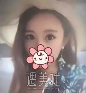 周口缔莱美整形医院双眼皮技术如何?有相关案例分享吗?