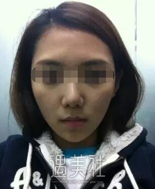 淄博中心医院整形科做玻尿酸除皱的果如何?我想改变自己~