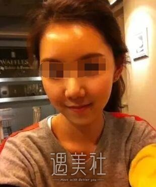 淄博中心医院整形科做玻尿酸除皱的果如何?我想改变自己~