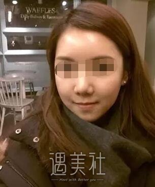 淄博中心医院整形科做玻尿酸除皱的果如何?我想改变自己~