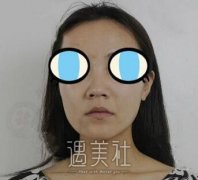 李战强硅胶垫鼻子案例分享，这个鼻子的鼻型我爱了！ width=