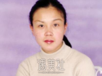 刘光明整容前后
