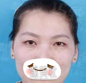 秦皇岛,巧致,双眼皮