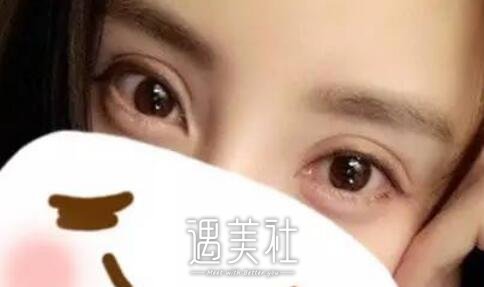秦皇岛,巧致,双眼皮