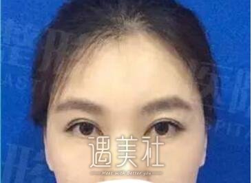 秦皇岛,巧致,双眼皮