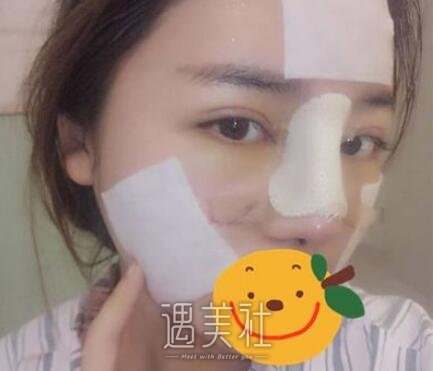 余娇,隆鼻