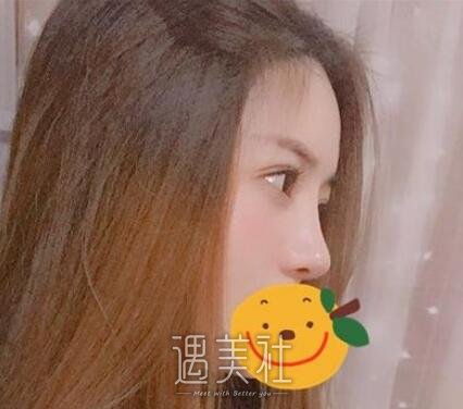 余娇,隆鼻