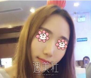 黄文,隆鼻