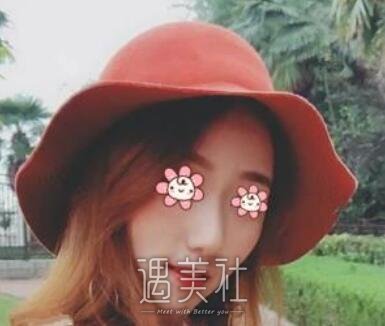 黄文,隆鼻