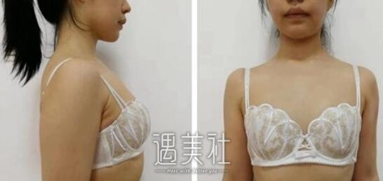 刘成胜,丰胸